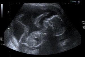 unborn_baby_at_20_weeks_credit_steve_via_flickr_cc_by_nc_20_cna